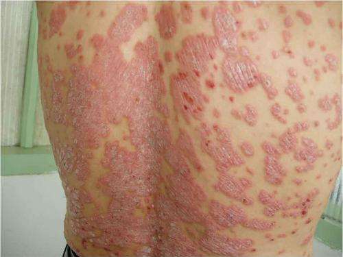 患者们应该怎么做恢复牛皮癣