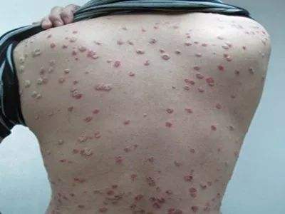 银屑病初起有哪些病症对人体伤害严重吗