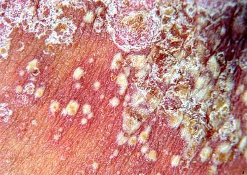 患有牛皮癣疾病如果复发会怎么样应该要怎么做