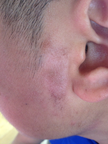 广州重点牛皮癣医院:治疗牛皮鲜存在哪些误区呢