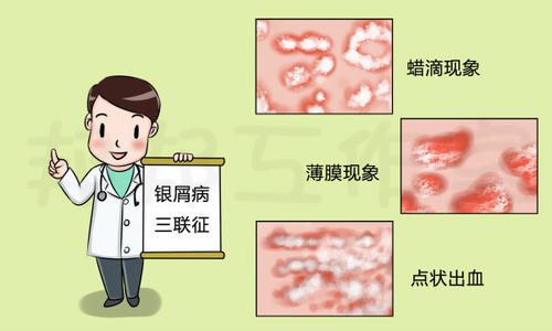 为什么吃了这么多银屑病药物却不见好