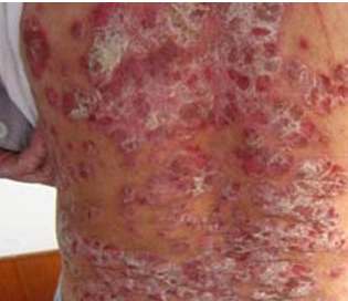 牛皮癣治愈后会留疤吗