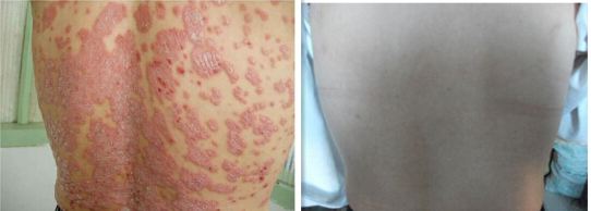 关于牛皮癣患者们要怎么去预防它呢