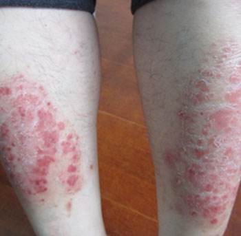 什么引发了银屑病有哪些因素