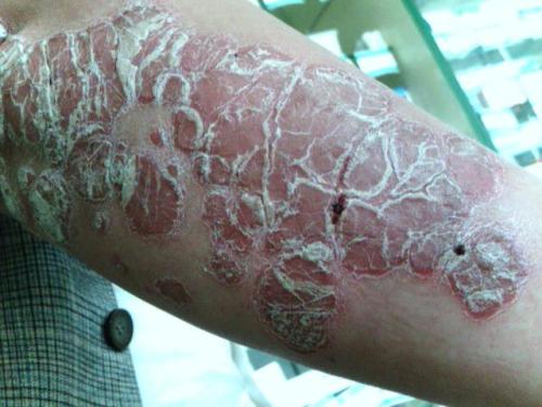 什么是关节病型牛皮癣