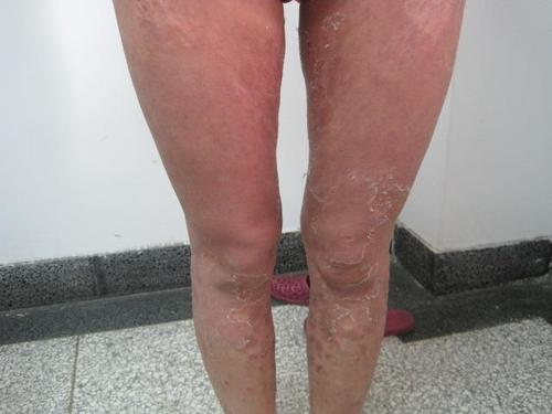 年轻人的年纪却有老年人的身体难怪银屑病会找上你