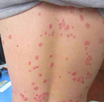 能有效治牛皮癣的医院有哪些