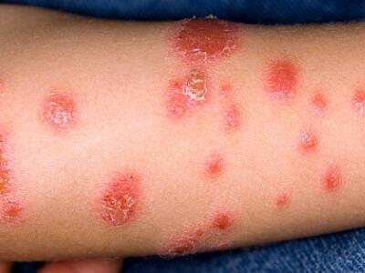 不掌握牛皮癣的发病症状如何才能治疗康复