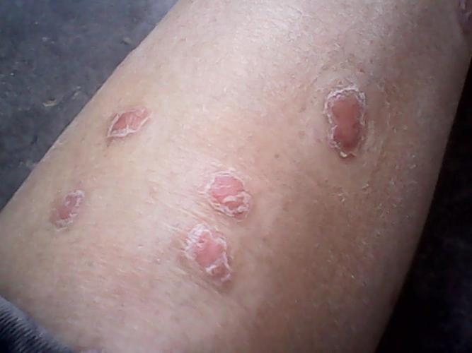 中老年人如何预防牛皮癣